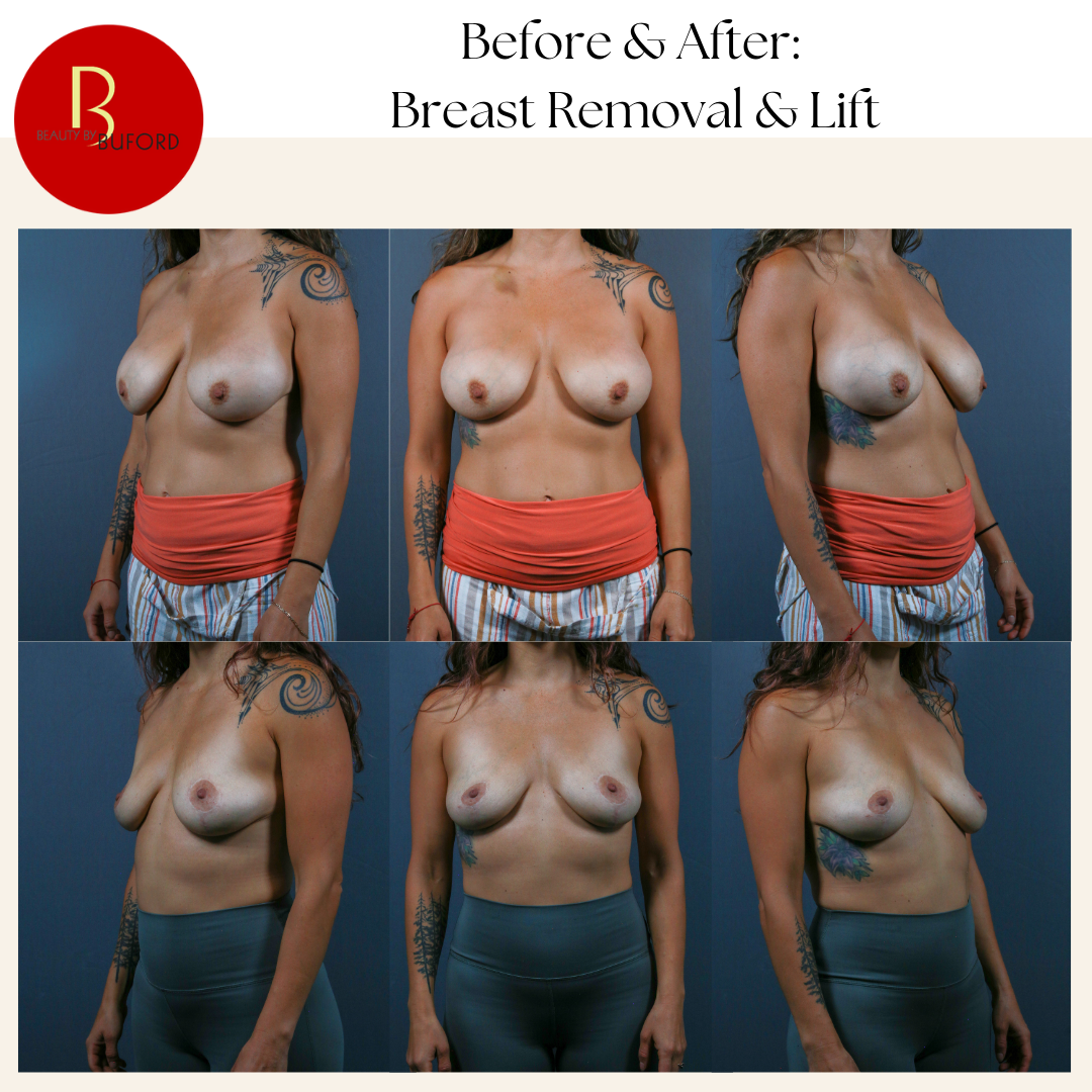 Breast Implant Removal + Lift
