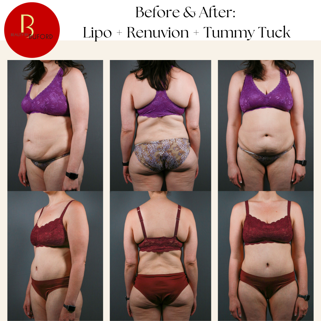 Liposuction, Tummy Tuck, and Renuvion