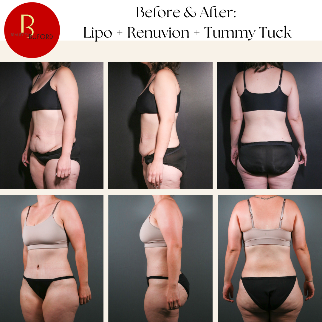 Liposuction, Tummy Tuck, and Revuvion