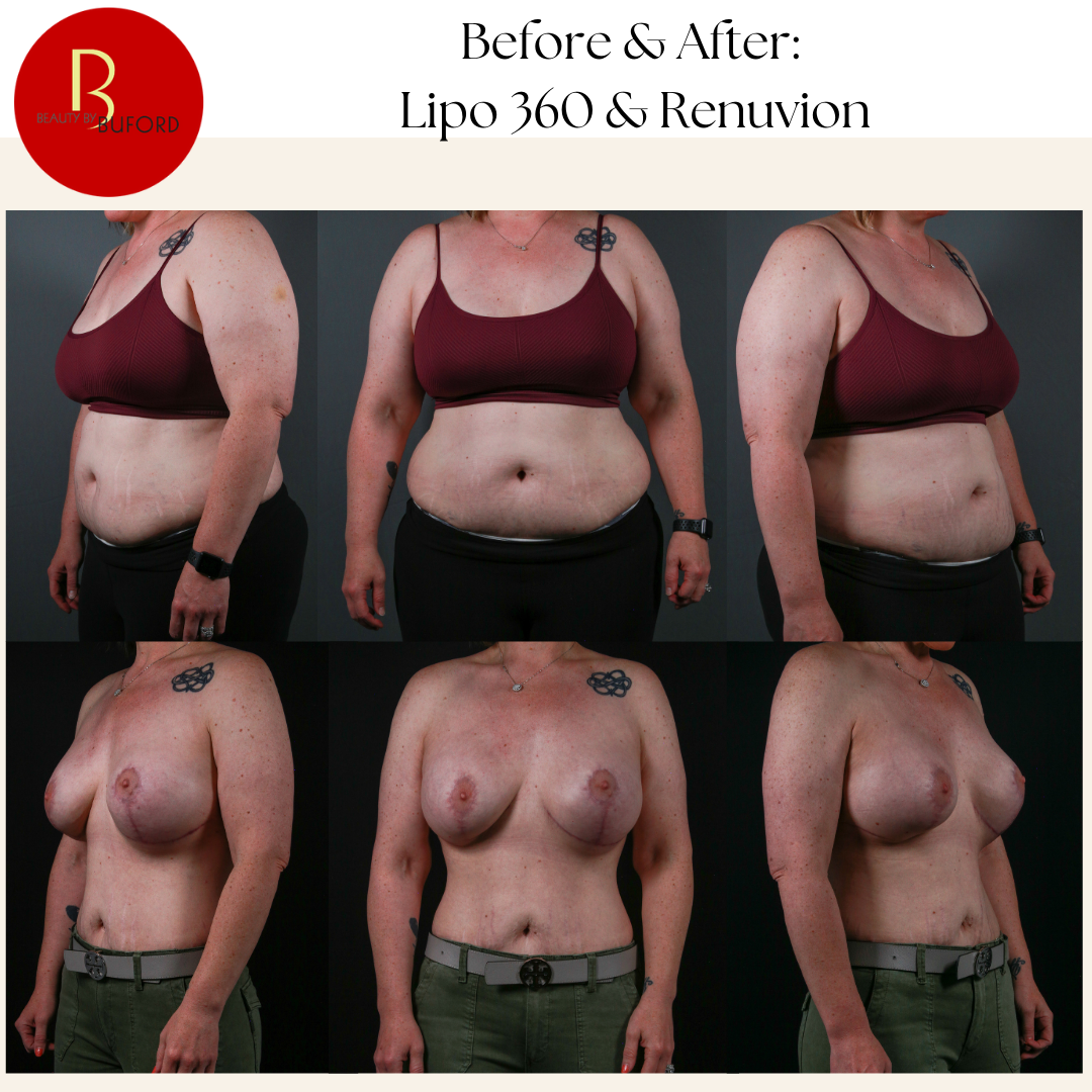 Liposuction and Renuvion