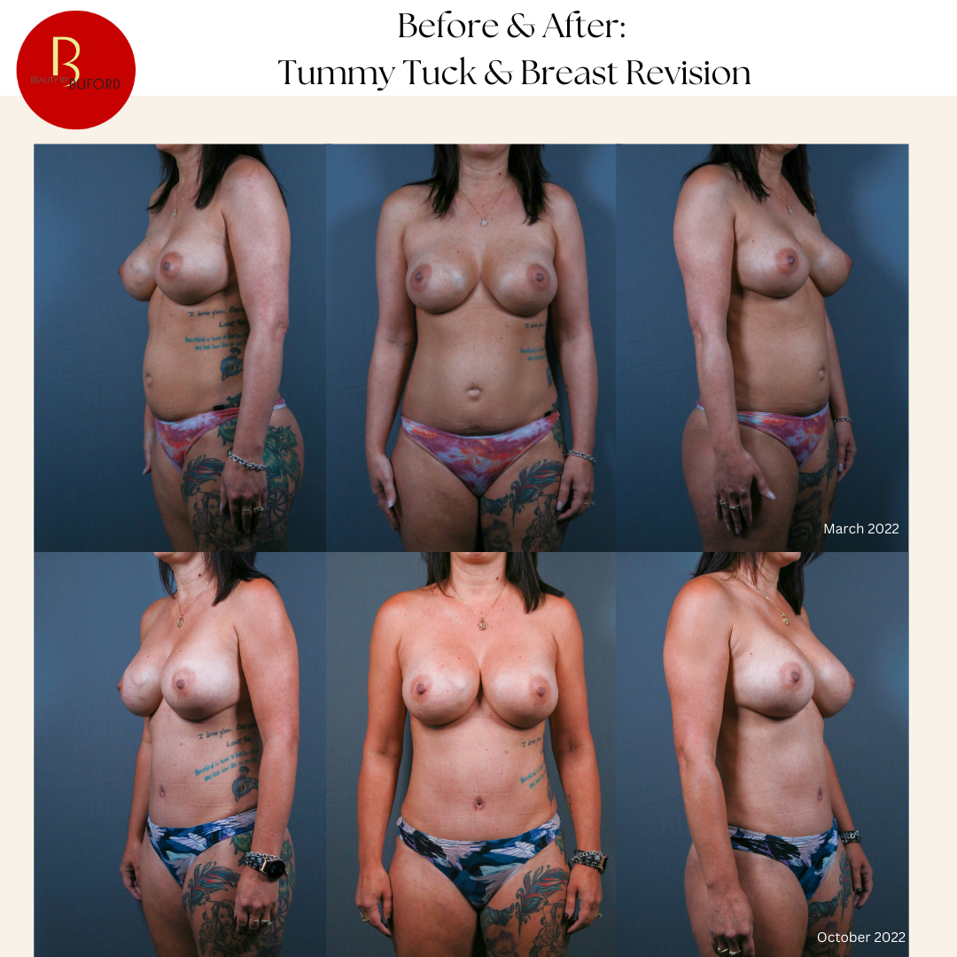 Tummy Tuck and Revision