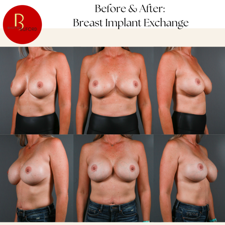 Breast Augmentation 46
