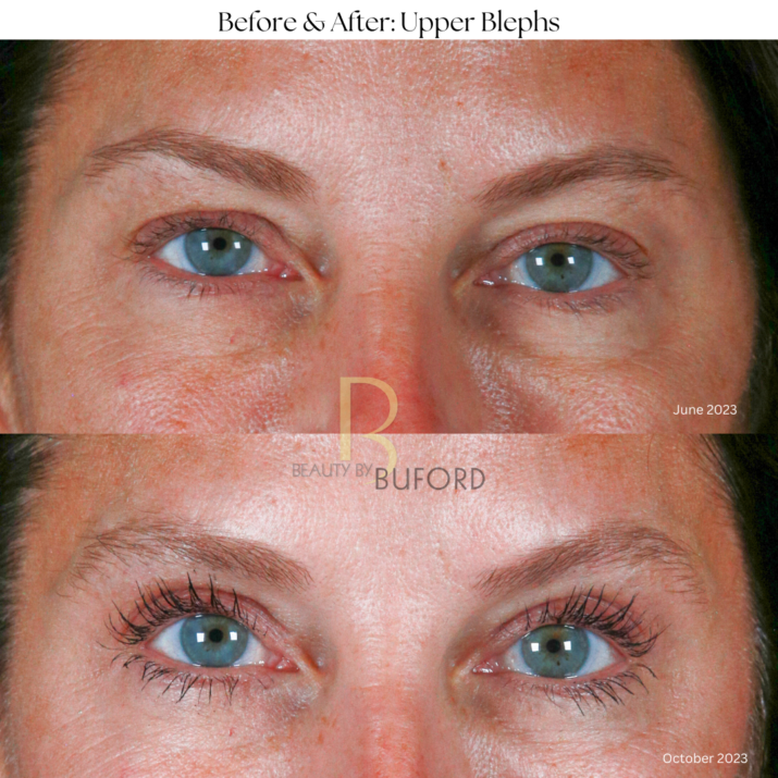 Eye Lift