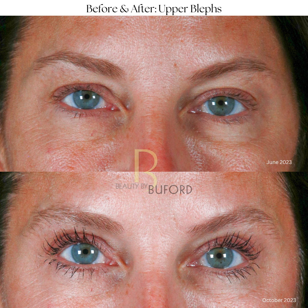 Eye Lift