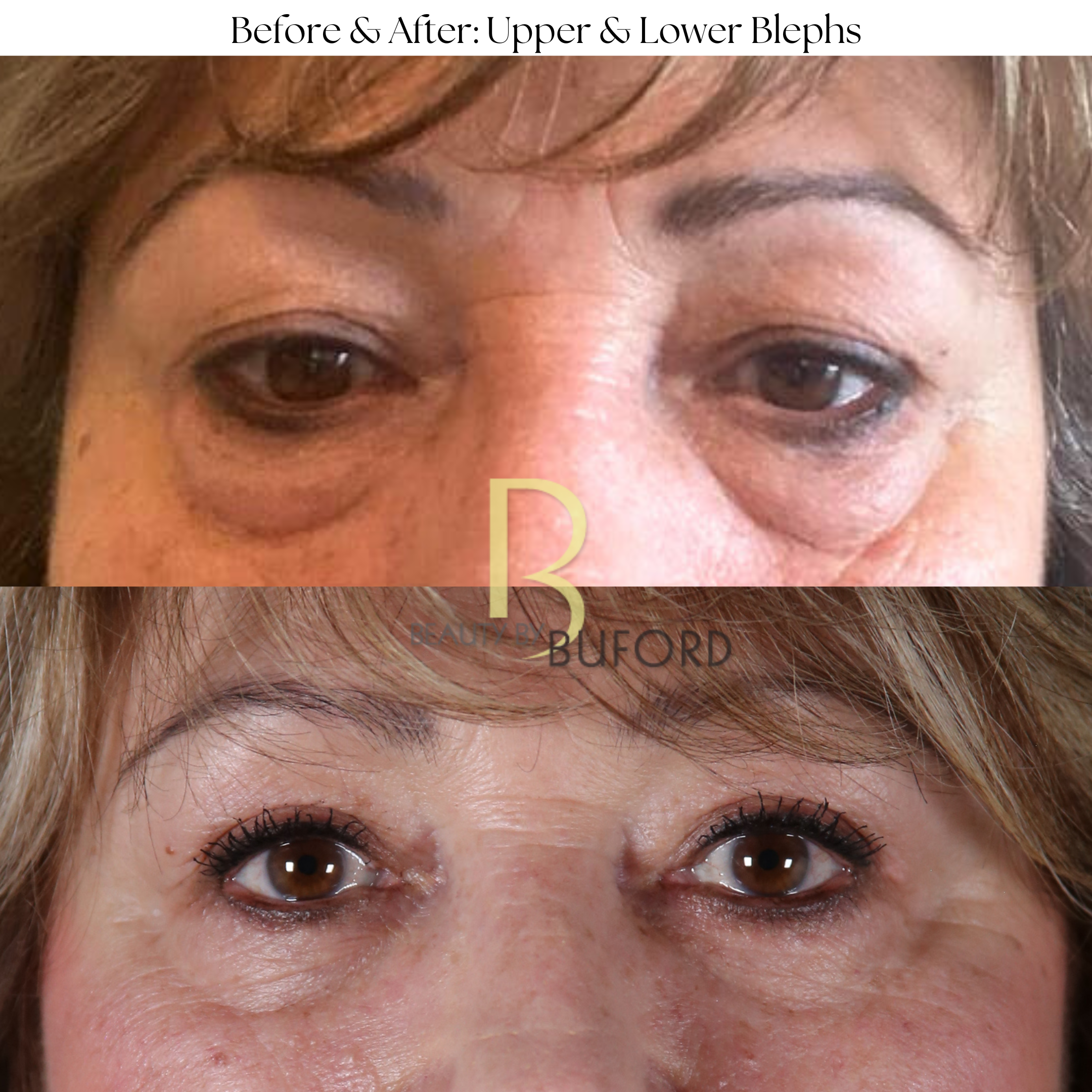 Eye Lift