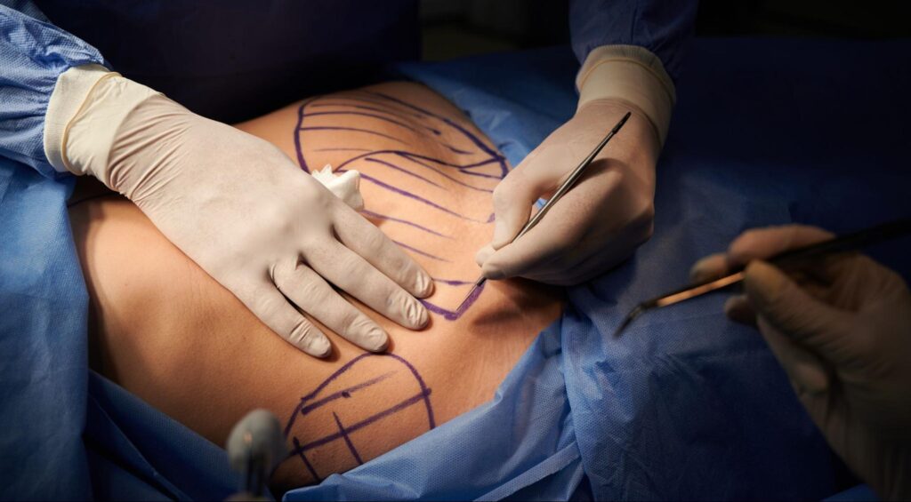 Can A Tummy Tuck Improve Abdominal Contouring?