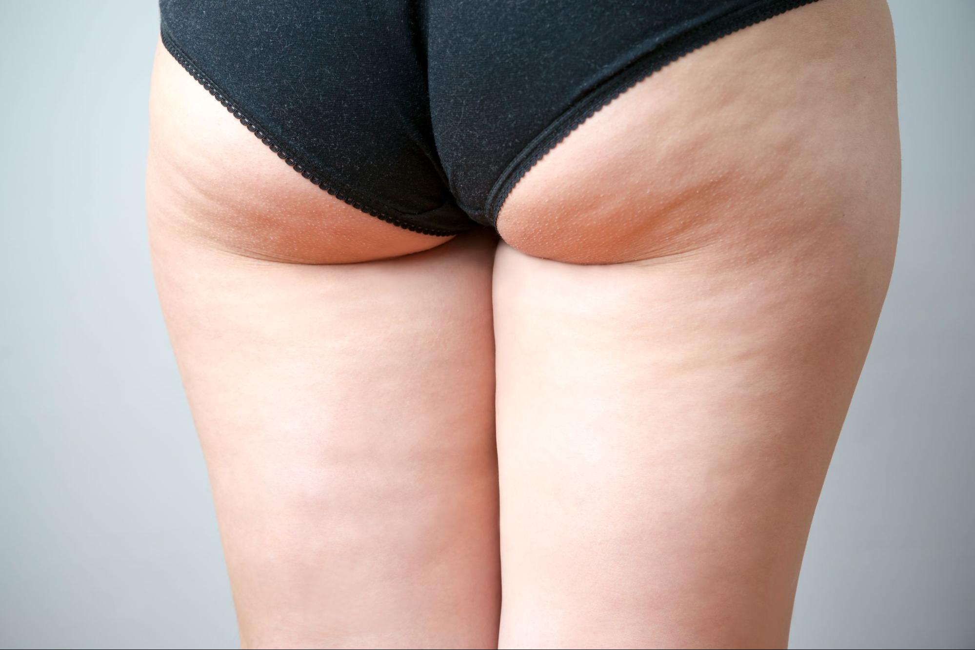 Why Choose Avéli™ for Cellulite Treatment?